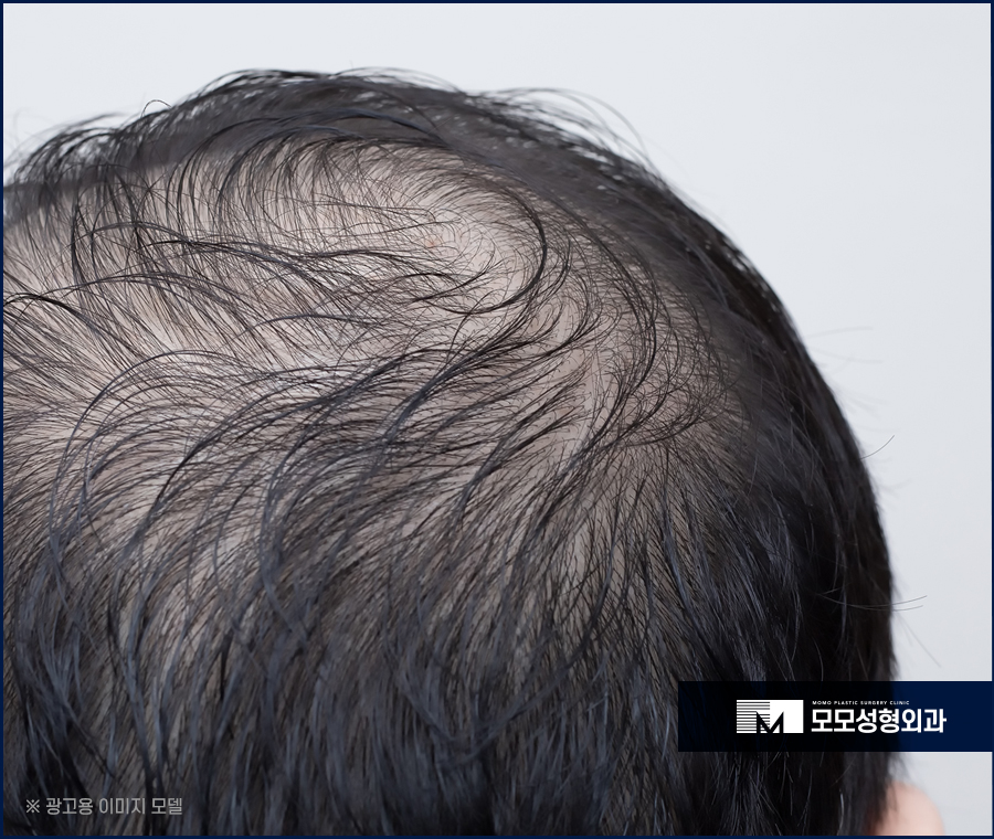 두피열내리기 방법과 중요한 이유까지 알아보는 관련 이미지 3