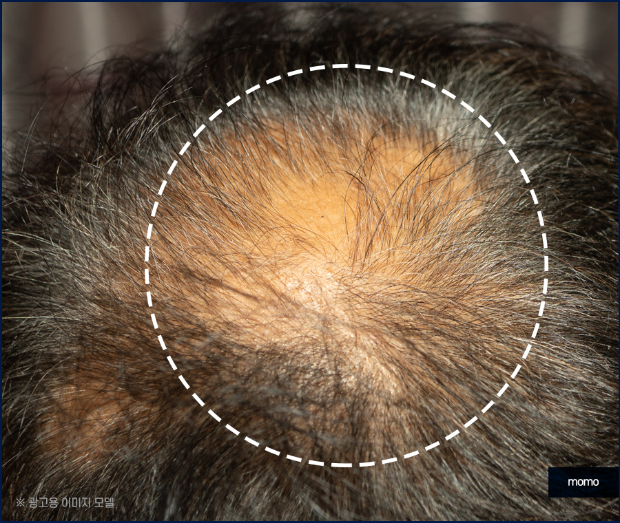압구정 모발이식 건강한 두피를 만드는 방법 관련 이미지 2