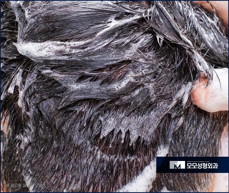 모발이식 1년이 지났을 때 경과가 좋으려면 관련 이미지 9