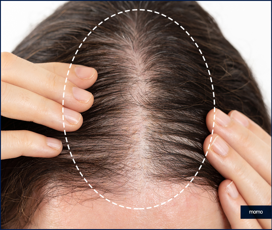 강남 모발이식 정교하게 보완하는 관련 이미지 2