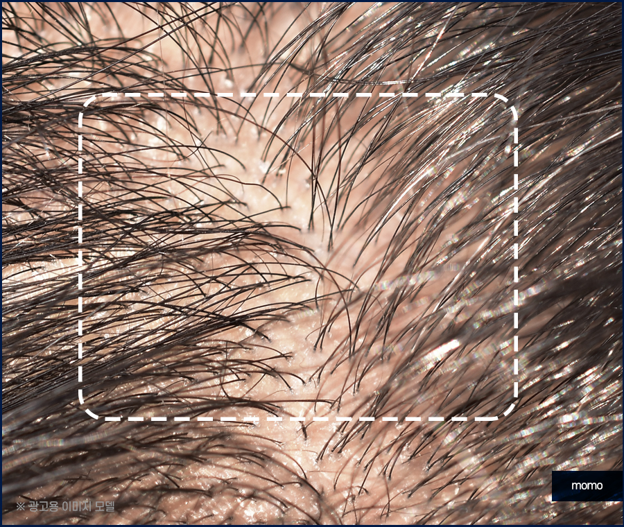 여자 정수리 탈모 모발이식 꼼꼼히 채우는 관련 이미지 10