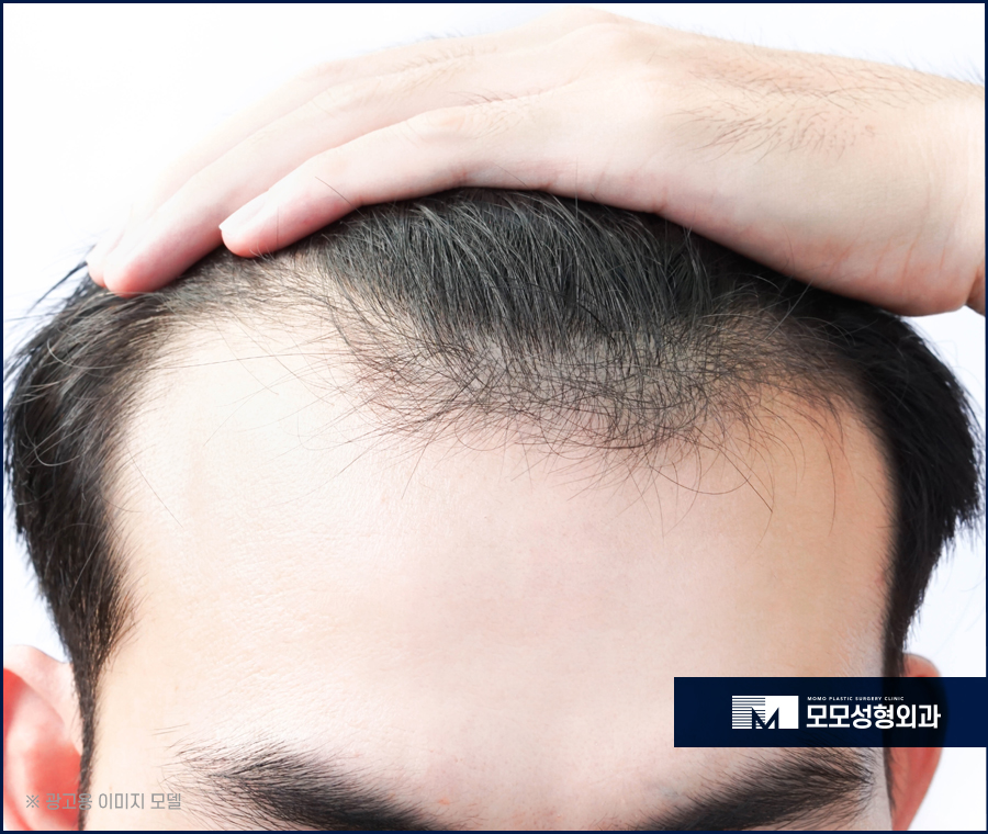 여자M자탈모 외모의 퀄리티를 더하는 보강 방법 관련 이미지 2