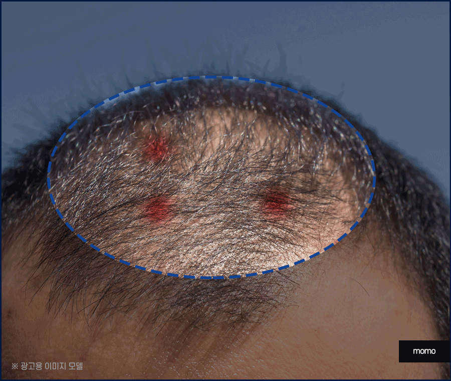 두피피딱지 원인 및 올바른 케어 방법은? 관련 이미지 4