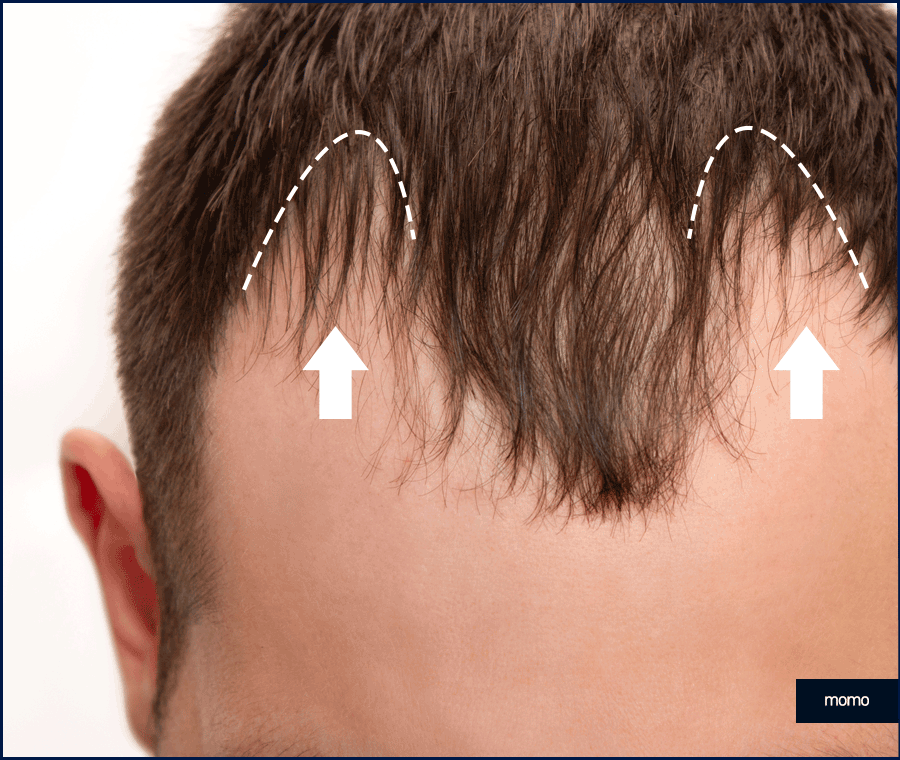 강남 모발이식 성공적인 변화를 만드는 꿀팁 관련 이미지 8