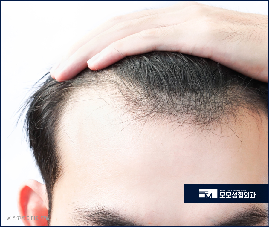 앞머리모발이식 자연스럽게 채워주는 관련 이미지 4