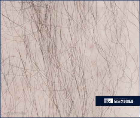 체모 이식 부위별 특성 고려해서 자연스런 결과로 관련 이미지 6