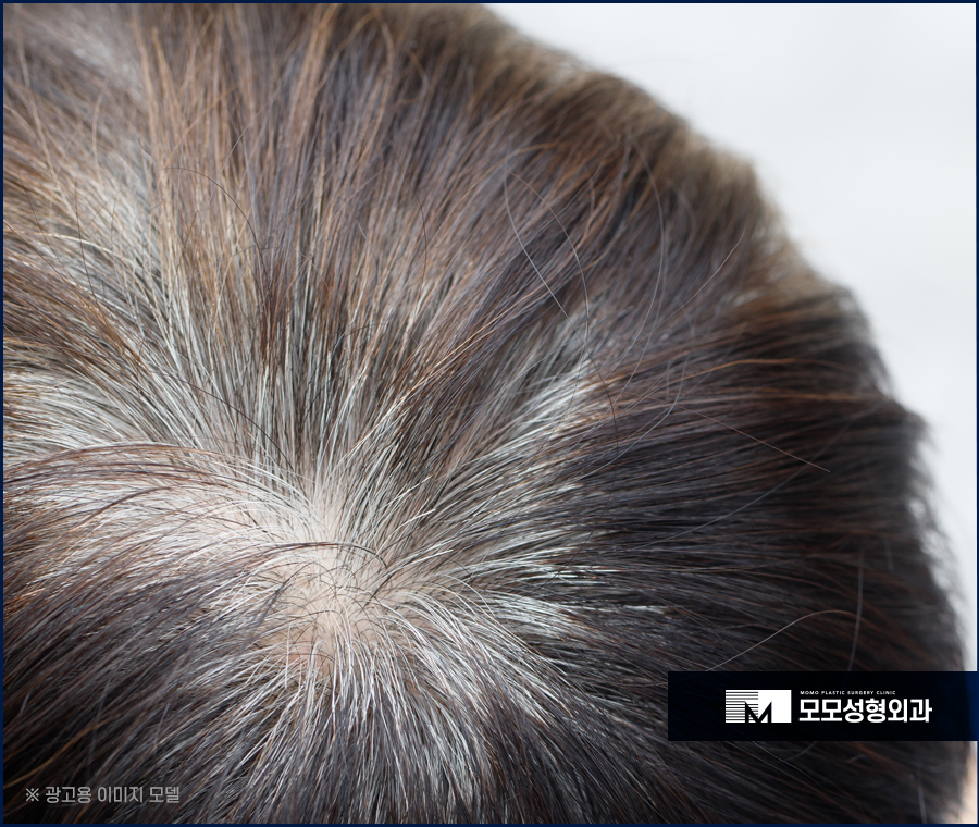 새치 흰머리 차이와 가볍게 잘라내야 하는 이유 관련 이미지 9