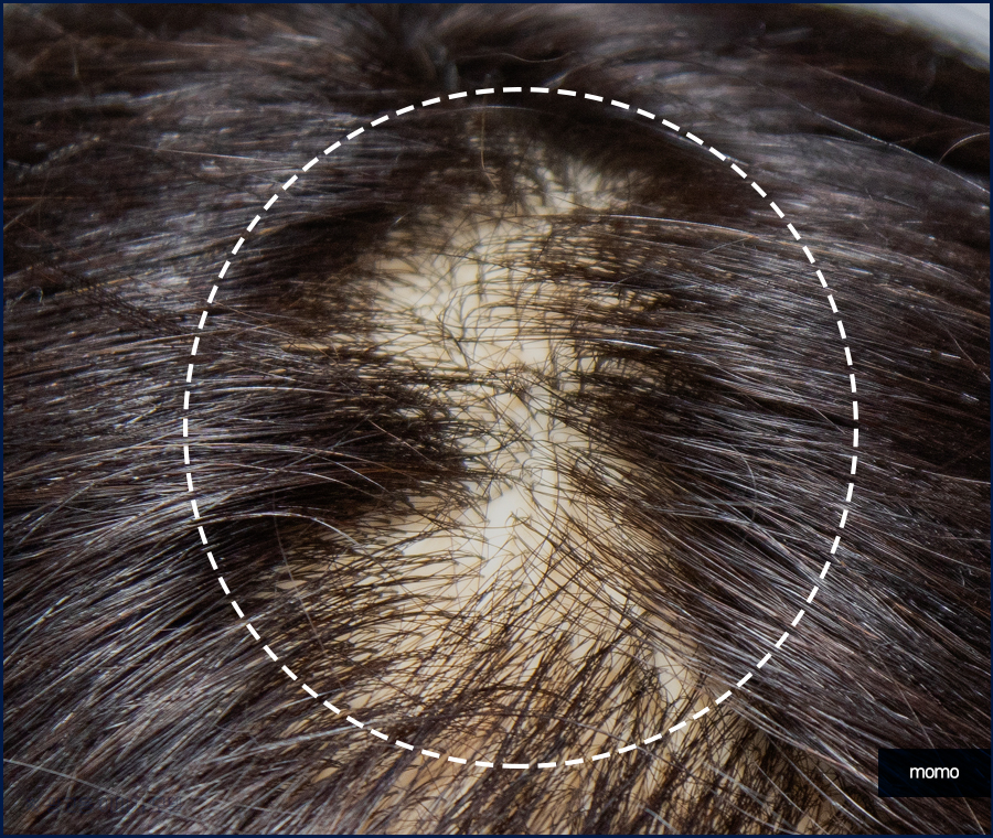 머리심기비용이 달라지는 이유와 차이점 관련 이미지 8