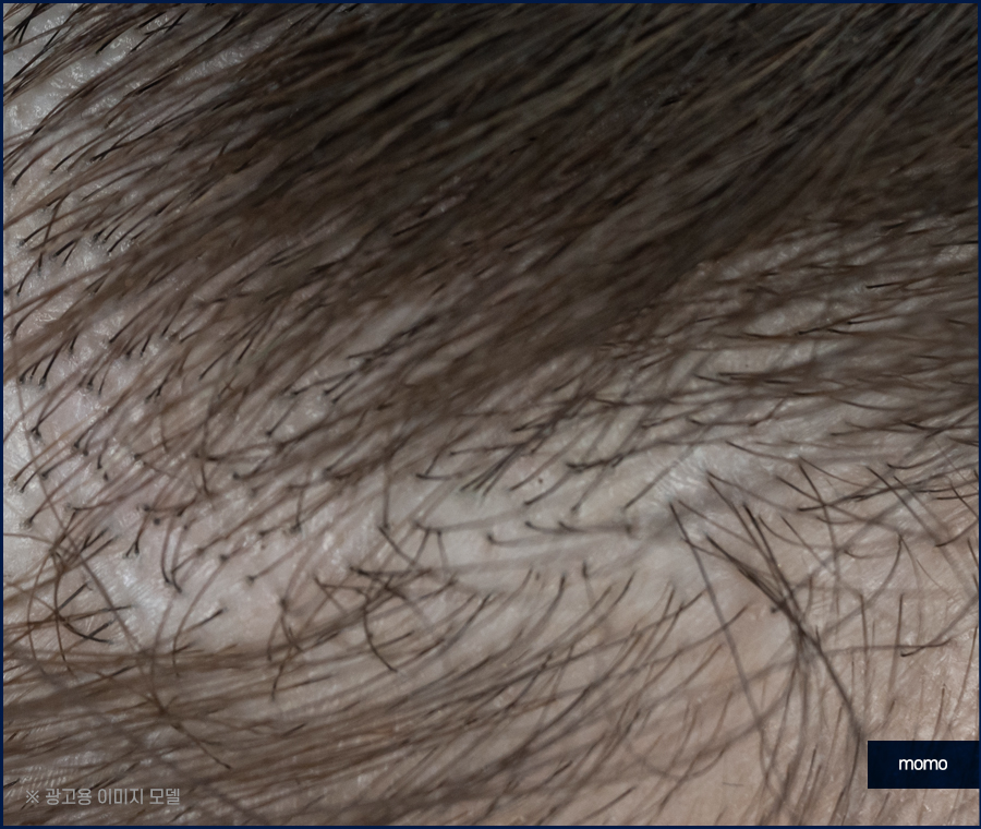 앞머리 모발이식 가격 차이부터 확인하며 관련 이미지 10