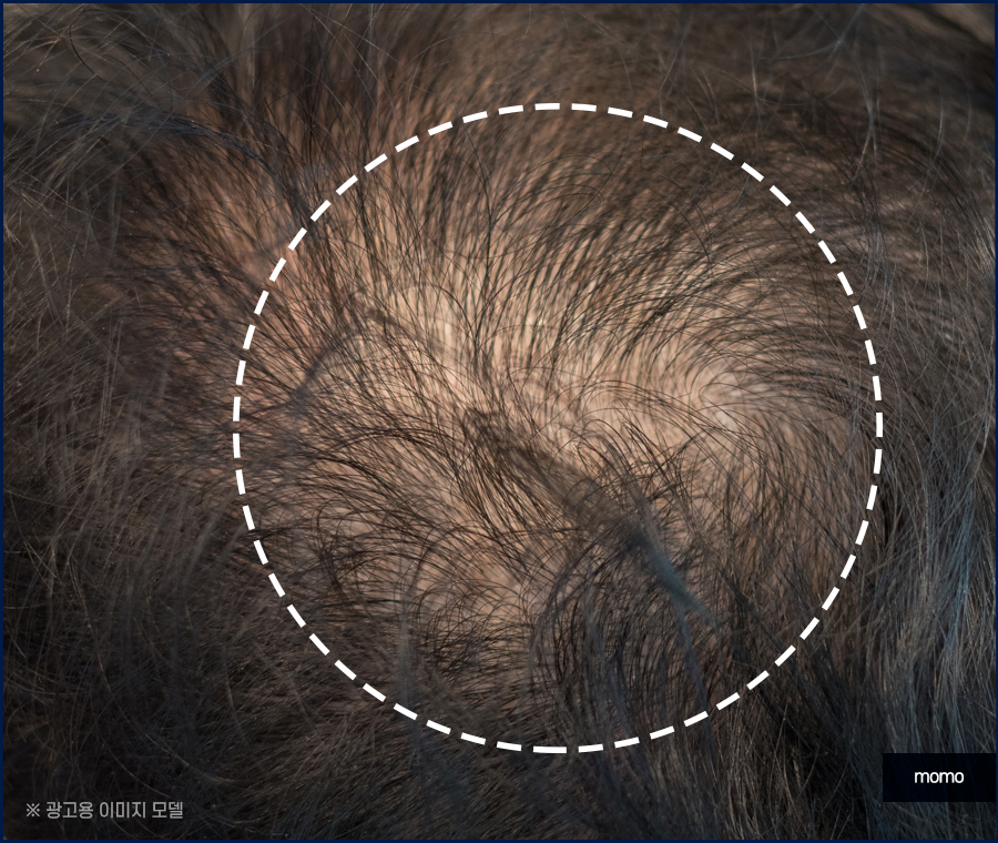 압구정 모발이식 건강한 두피를 만드는 방법 관련 이미지 7
