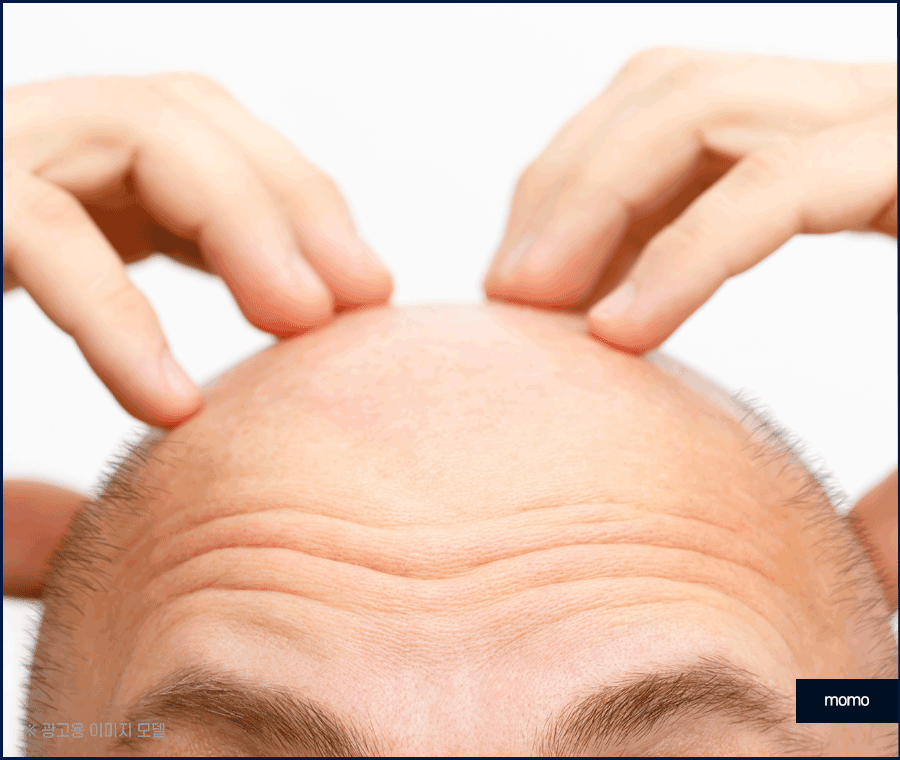 비절개 모발이식 후기와 함께 꼭 알아볼 이것! 관련 이미지 10