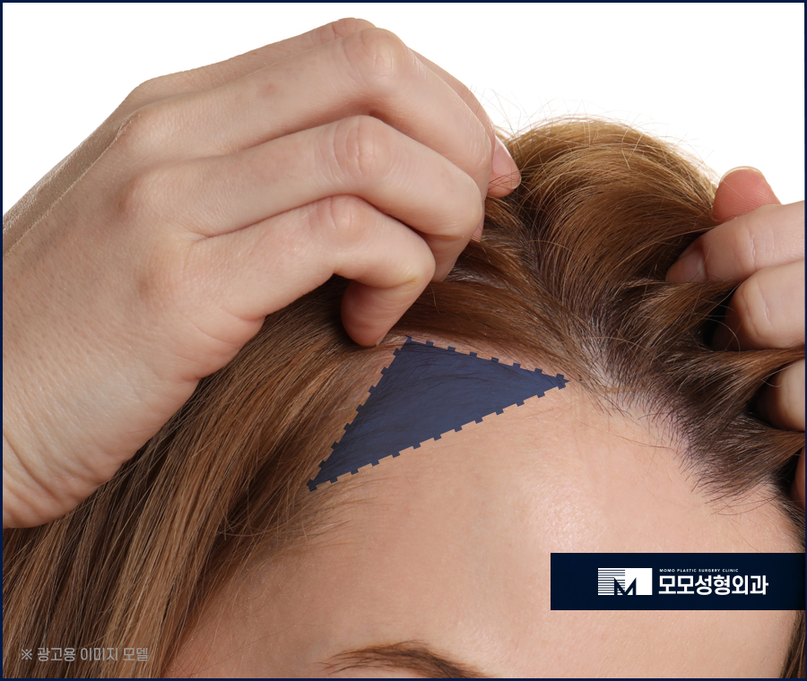 M자 모발이식 비용과 금액대가 달라지는 이유 관련 이미지 5