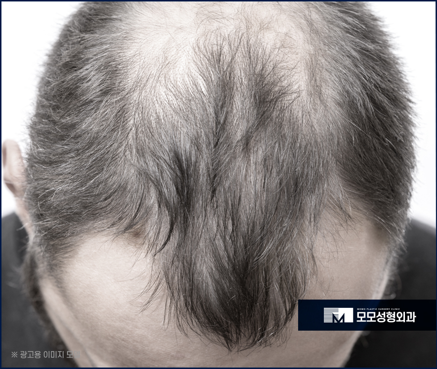 머리숱없는남자 커버가 아닌 보강을 원한다면 관련 이미지 4