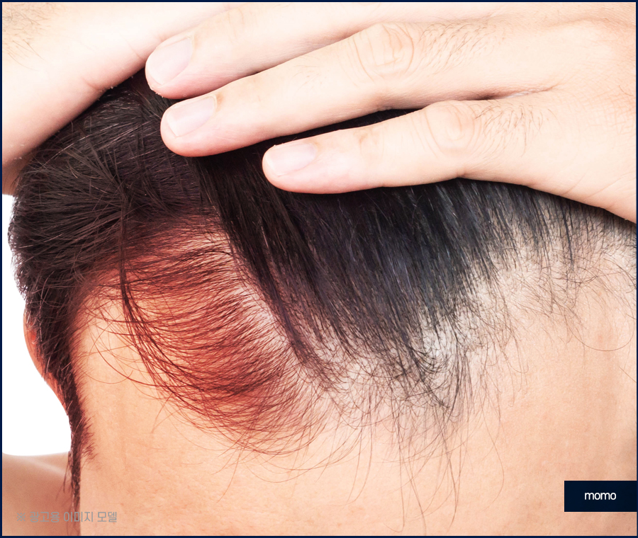 M자모발이식비용 가격 탈모 탈출을 위한 관련 이미지 5