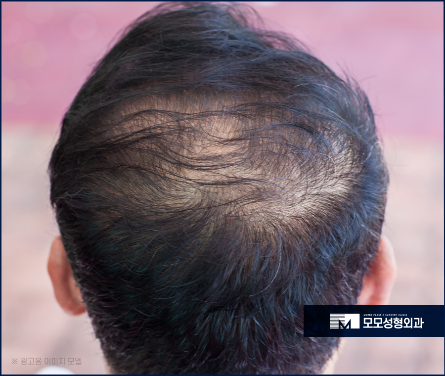 탈모전조증상 미리 알 수 있는 부분은 관련 이미지 5