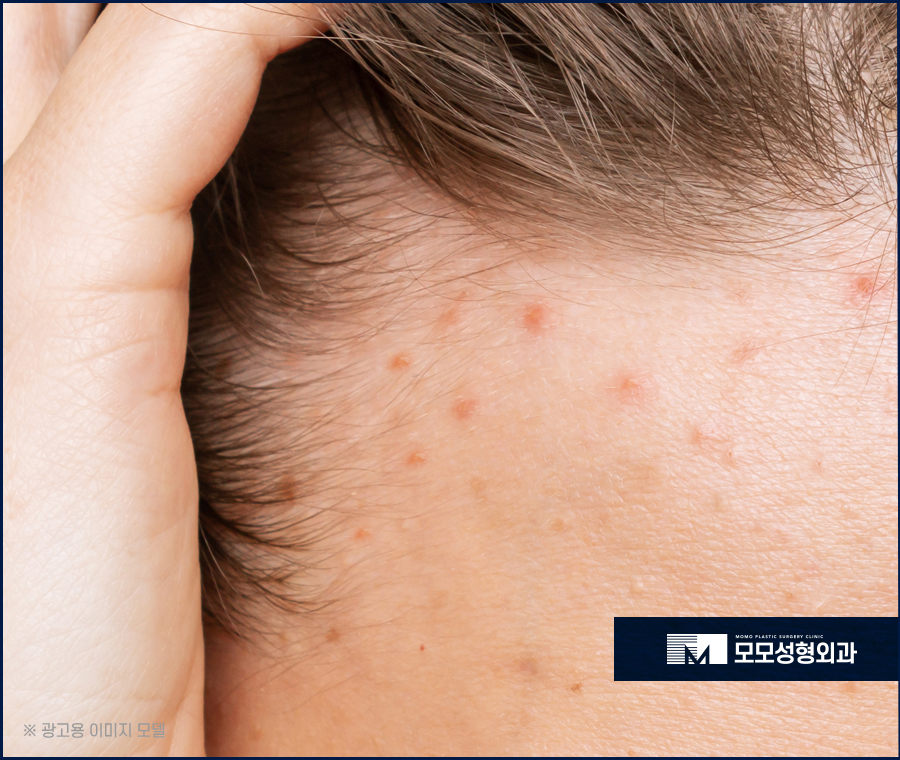 헤어라인좁쌀여드름 생성 원인과 해결법 관련 이미지 7