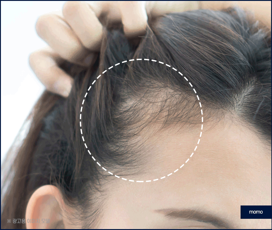 모발이식 2000모 자연스러운 커버 결과 정도는? 관련 이미지 8