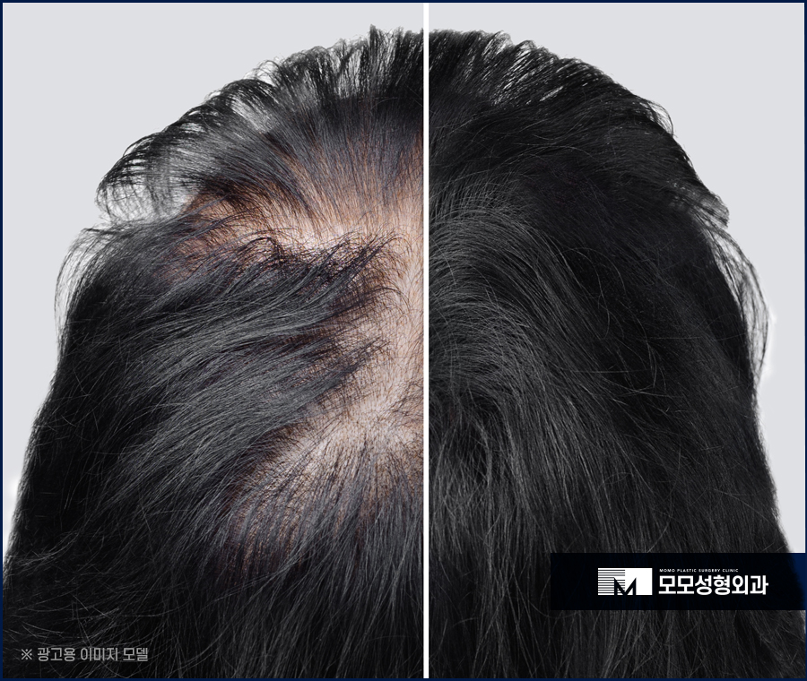 모발이식명의 효과를 위해 찾고 있다면 관련 이미지 6