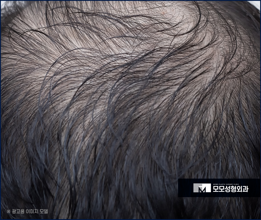 모발이식생착기간 여유를 가지고 기다려야하는 관련 이미지 3