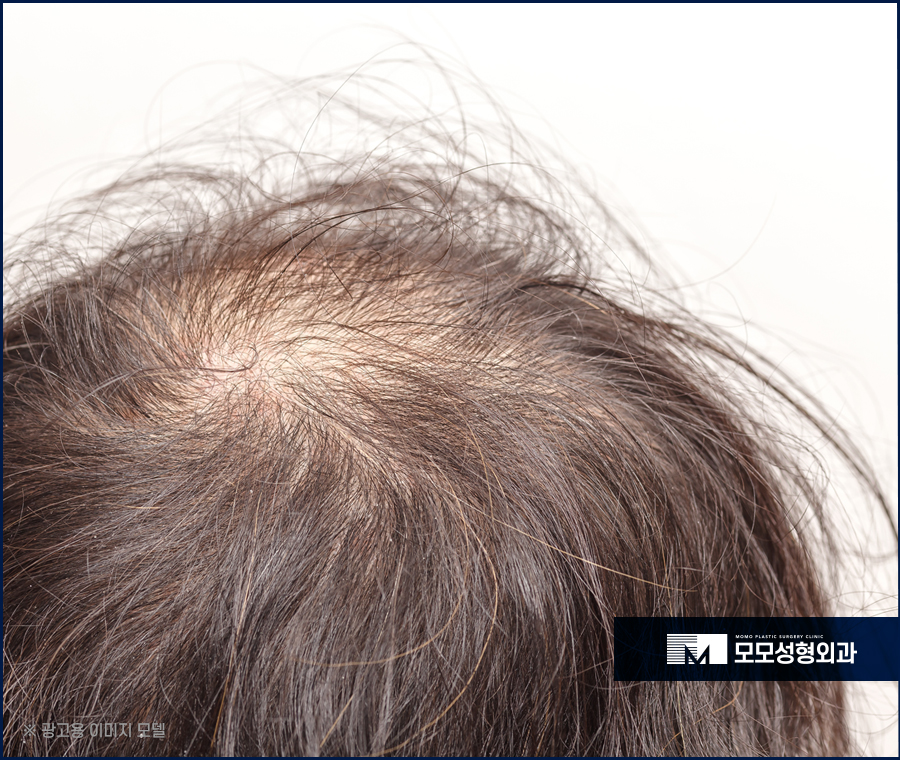 무삭발모발이식 빠른 회복을 위한 선택 관련 이미지 4