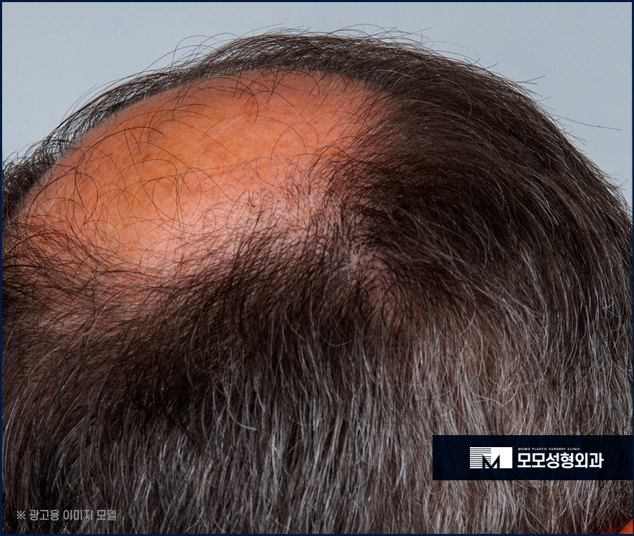 모발이식 암흑기를 이겨내기 위해 알아야 할 점 관련 이미지 8