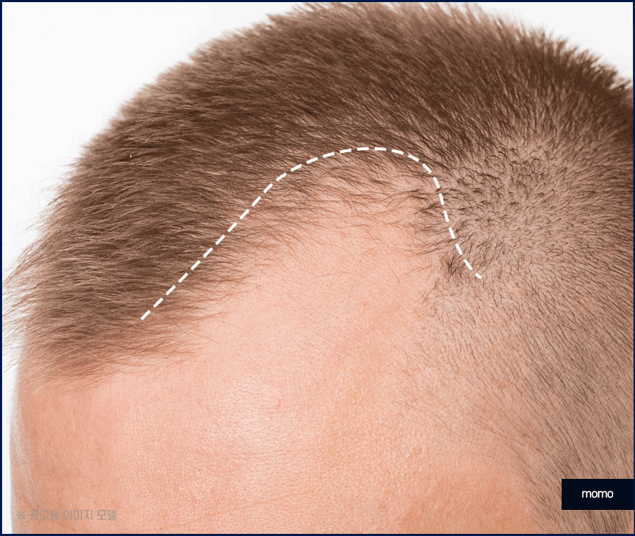 엠자이마 탈모 헤어라인 모발이식으로 관리하기 관련 이미지 6