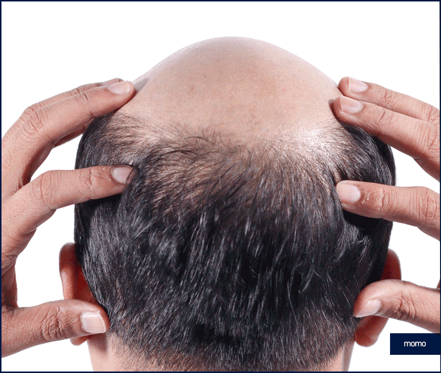 강남 모발이식 성공적인 변화를 만드는 꿀팁 관련 이미지 11