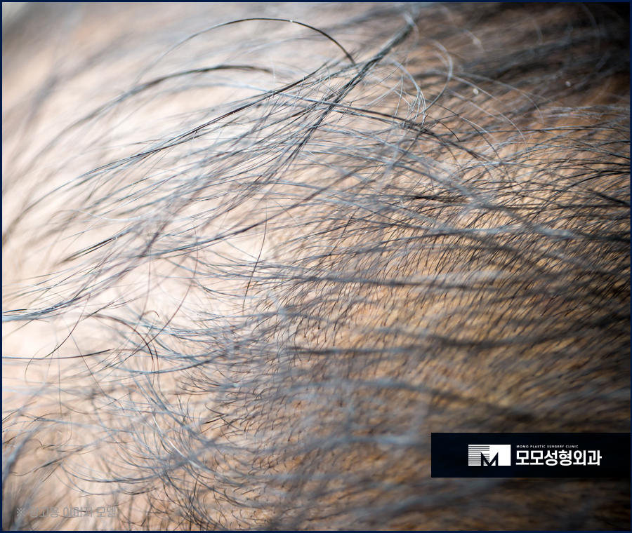 모발이식전후 선명한 차이를 느끼고 싶다면 관련 이미지 3