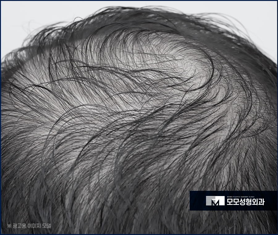 머리숱없는남자 커버가 아닌 보강을 원한다면 관련 이미지 2