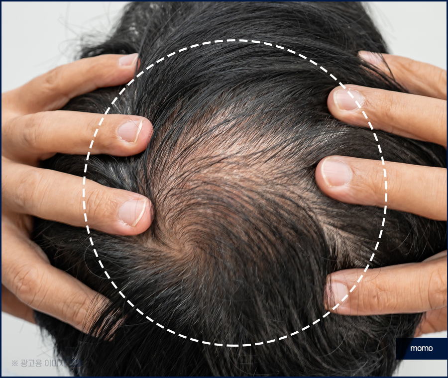 머리심기비용이 달라지는 이유와 차이점 관련 이미지 7