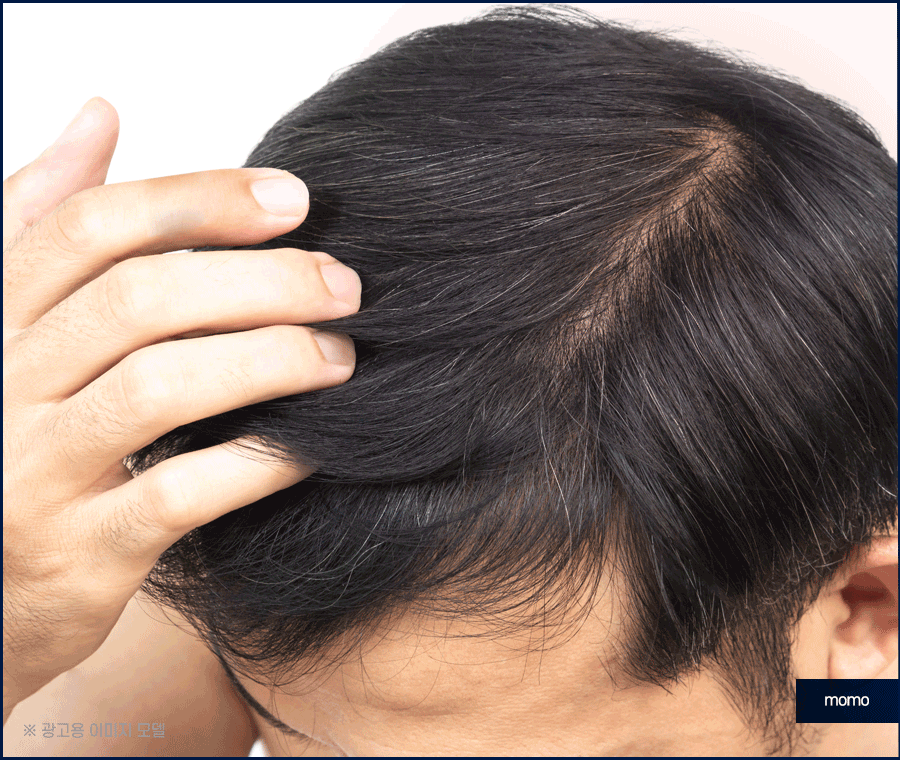 중학생탈모 발생 원인 및 보완하는 방법은? 관련 이미지 11