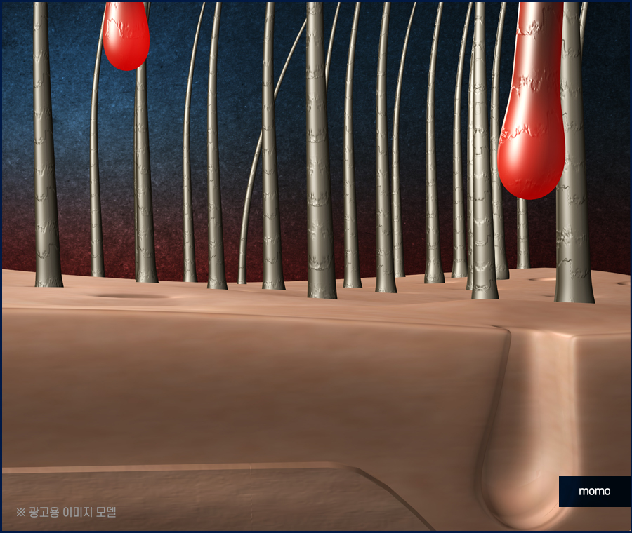 모발이식 생착률 기준짓는 요소들은 무엇일까 관련 이미지 8