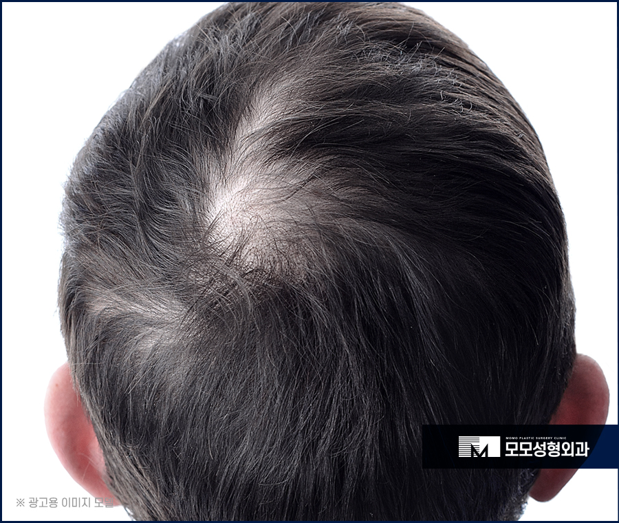 20대 모발이식 젊은 날의 외모 자신감을 위한 관련 이미지 4