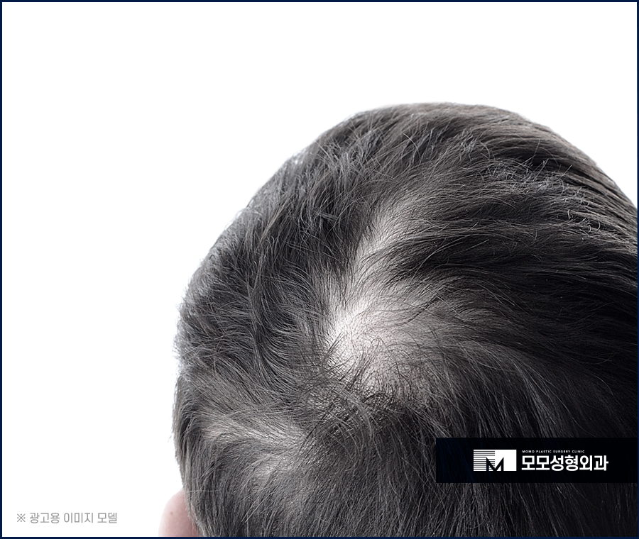 모발 얇아짐 심각성을 알고 경각심을 가져야만 관련 이미지 2