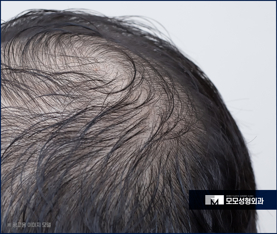 모발이식5000모 얼굴형까지 적절히 유념해서 관련 이미지 3