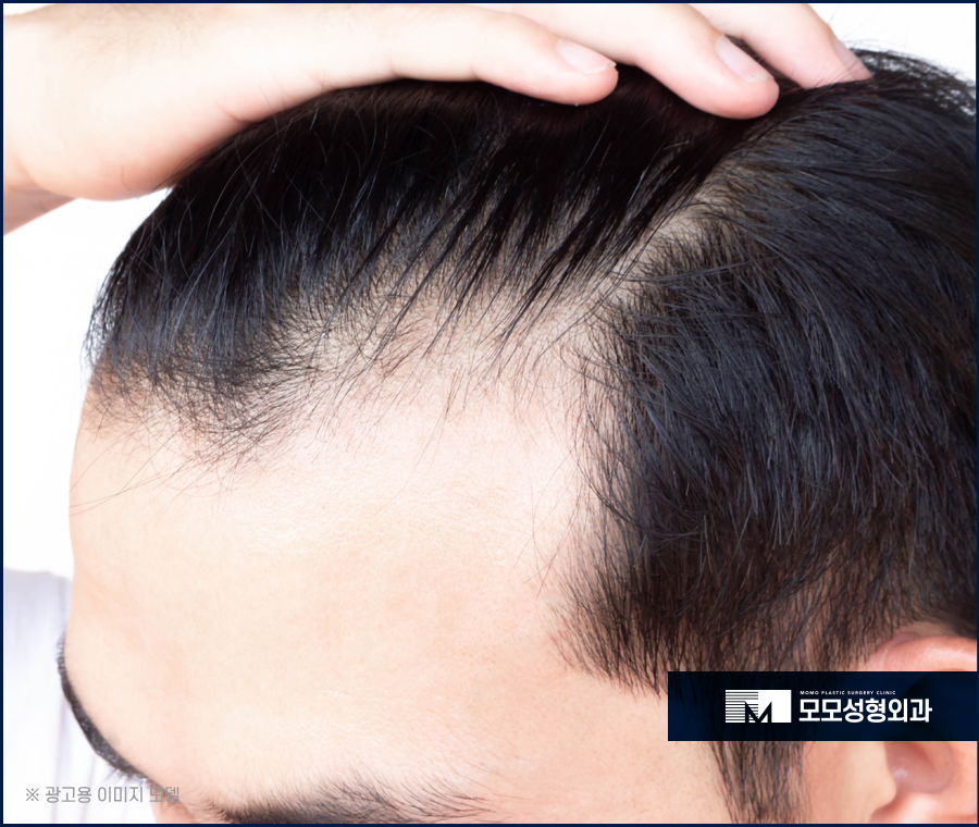 안드로겐성탈모 원인과 개선을 위한 방안은 관련 이미지 7