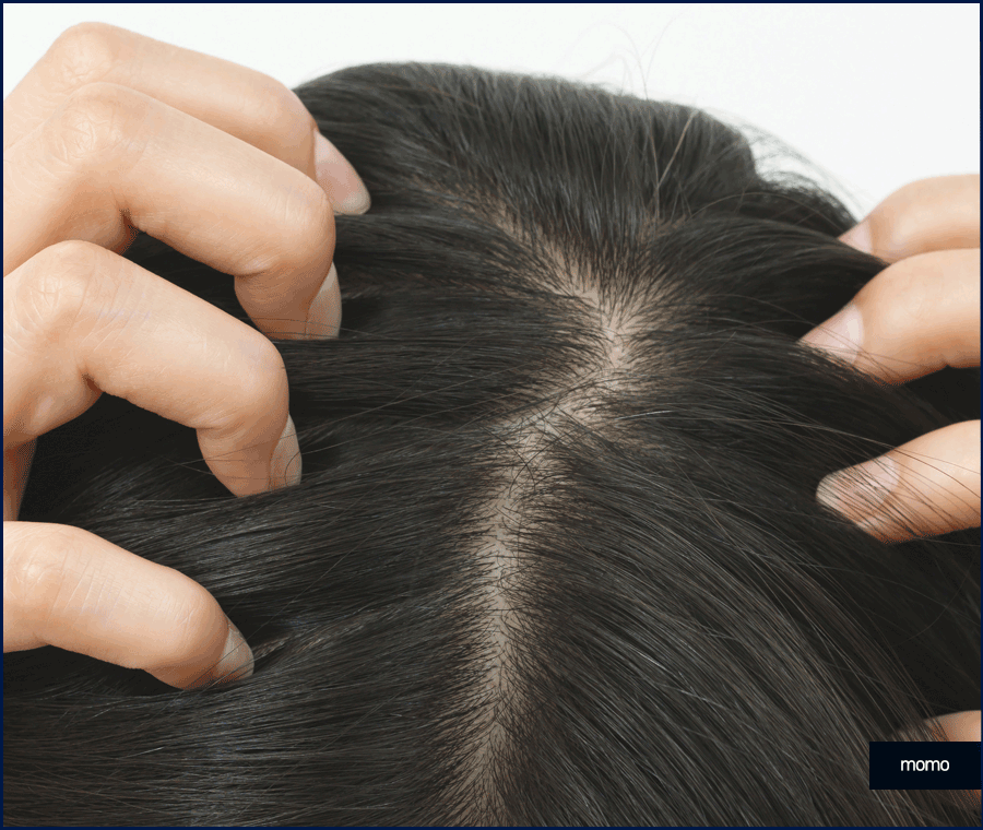 압구정 탈모병원 보완을 위한 최선책은? 관련 이미지 2