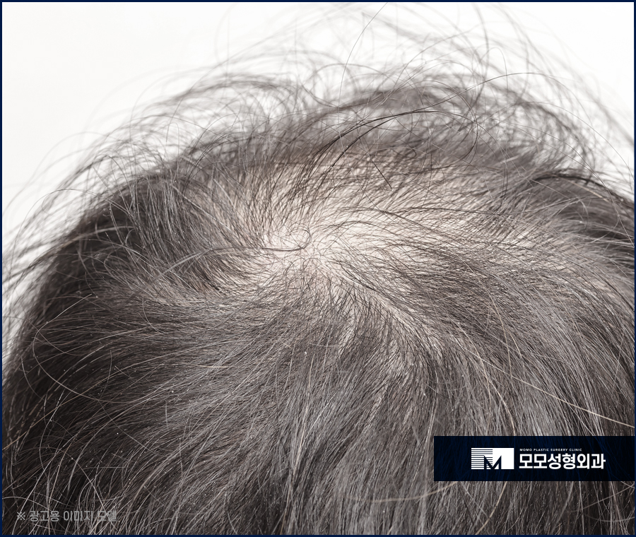 모발이식회복기간 및 반드시 알고 있어야 할 점 관련 이미지 2