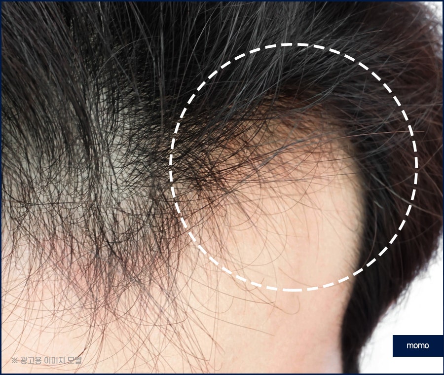 모발이식 생착률 극대화 하려면 관련 이미지 9