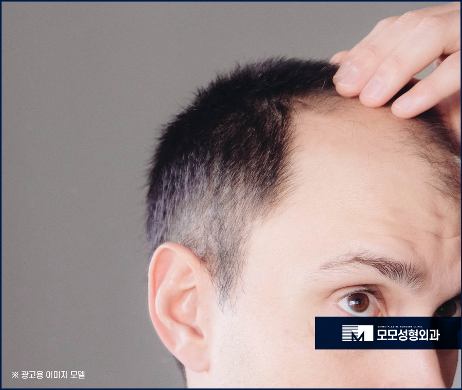 비절개모발이식 히든컷 멋스러움을 더해 관련 이미지 3