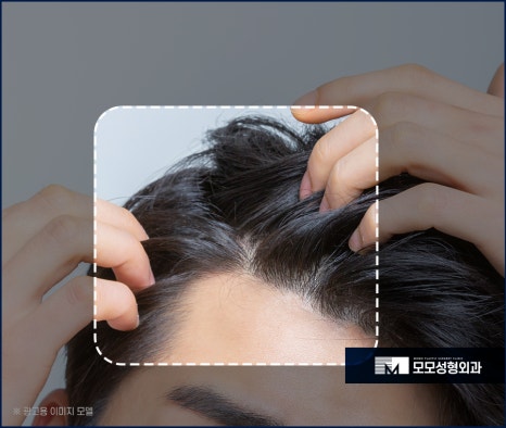 신사역 모발이식 디자인이 중요시 여겨지는 이유 관련 이미지 3