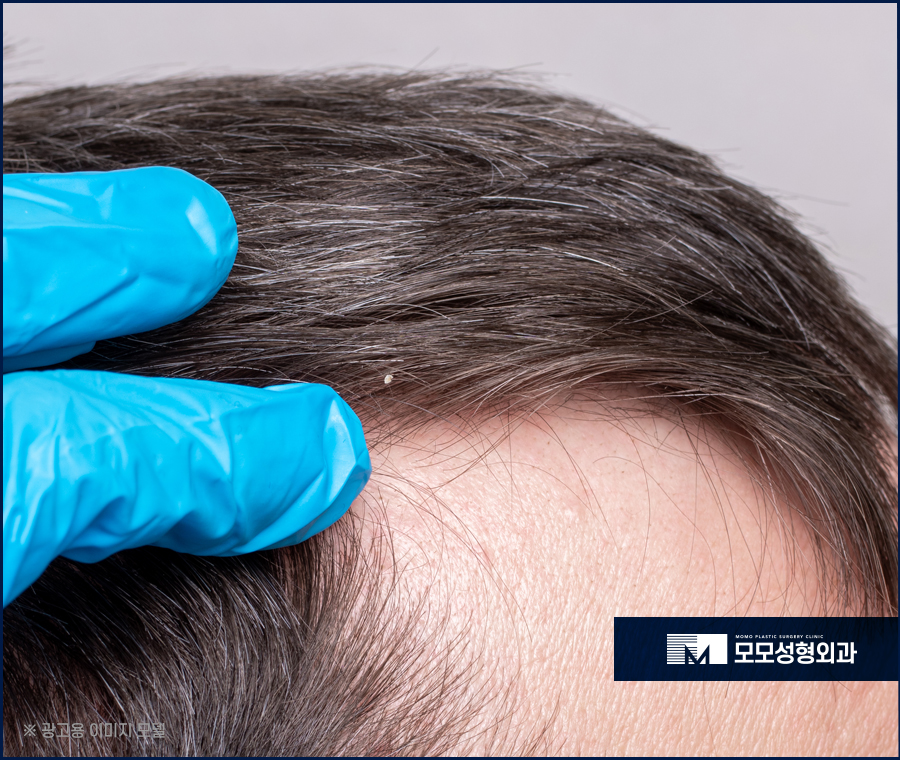 엠자탈모 초기 어떤 증상들이 동반될까요 관련 이미지 6