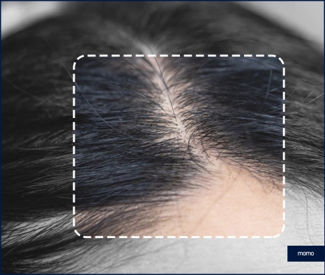 여성 모발이식 자연스러운 변화를 만드는 관련 이미지 3