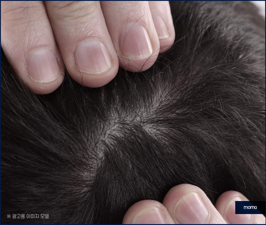 모발이식 생착기간 생착률 및 주의할 점 확인 관련 이미지 8