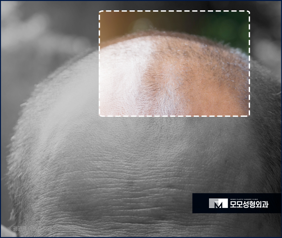 모발 얇아짐 이유와 두께를 복구하는 방법 관련 이미지 6