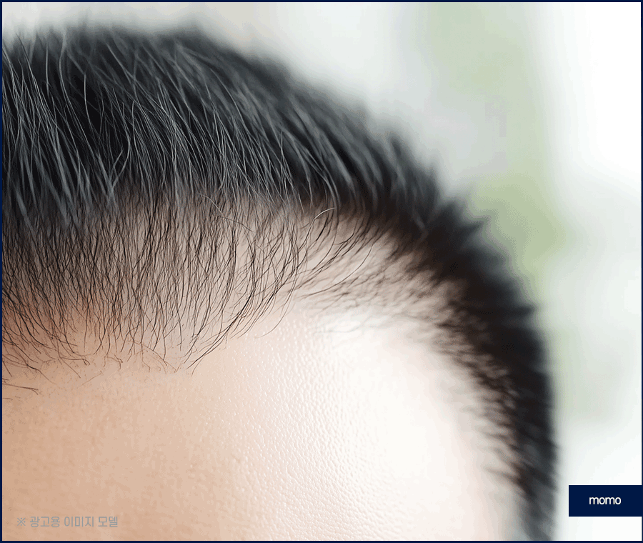 압구정 헤어라인 모발이식 라인 디자인으로 높인 완성도 관련 이미지 9