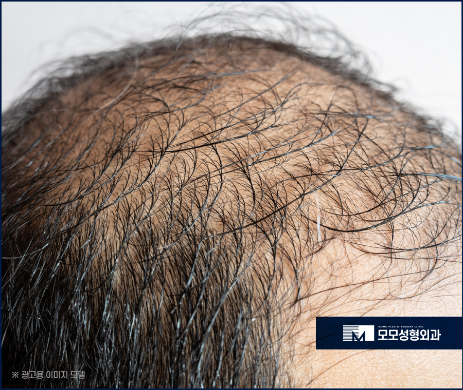 m자탈모초기증상 면밀하게 관찰해야 하는 이유 관련 이미지 2