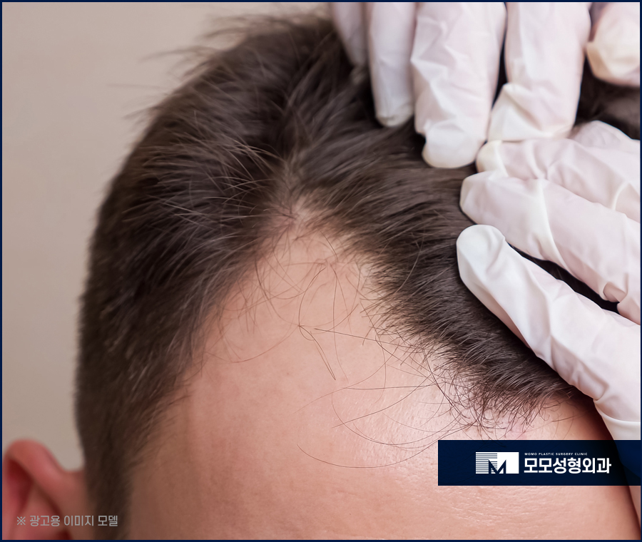 모발이식 재수술 실수가 다시 나타나지 않는 방향으로 관련 이미지 4