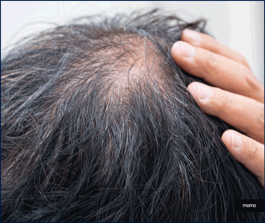 압구정 헤어라인 모발이식 라인 디자인으로 높인 완성도 관련 이미지 10