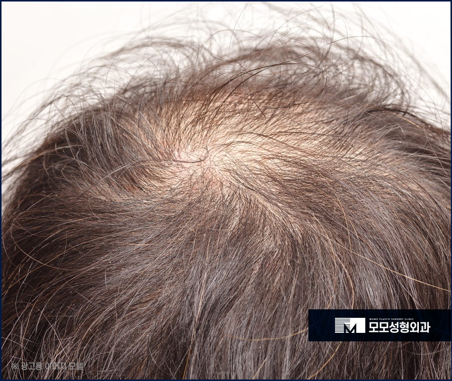 정수리탈모치료비용 만족스러울 수 있도록 관련 이미지 2